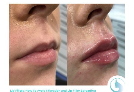 Lip Fillers: How To Avoid Migration and Lip Filler Spreading