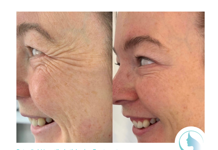 Botox®: A Versatile Anti-Ageing Treatment